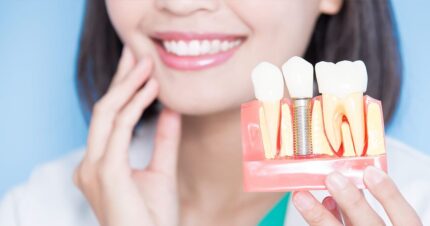 Implante dente em Itapema
